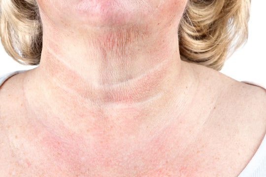 Microneedling for Crepey Skin