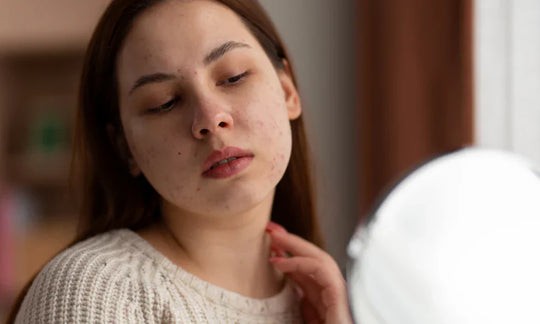 Comment aider votre peau à guérir naturellement et atténuer les cicatrices d’acné