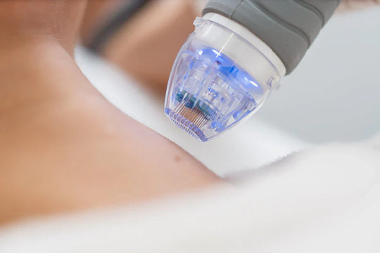Microneedling After One Session