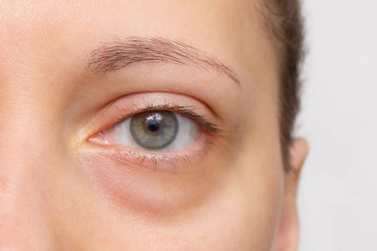 Microneedling Under Eyes