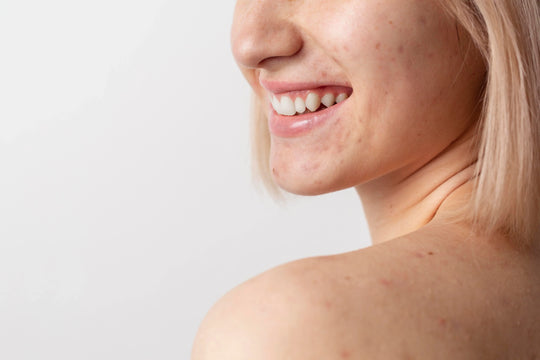 Red Light Therapy for Acne